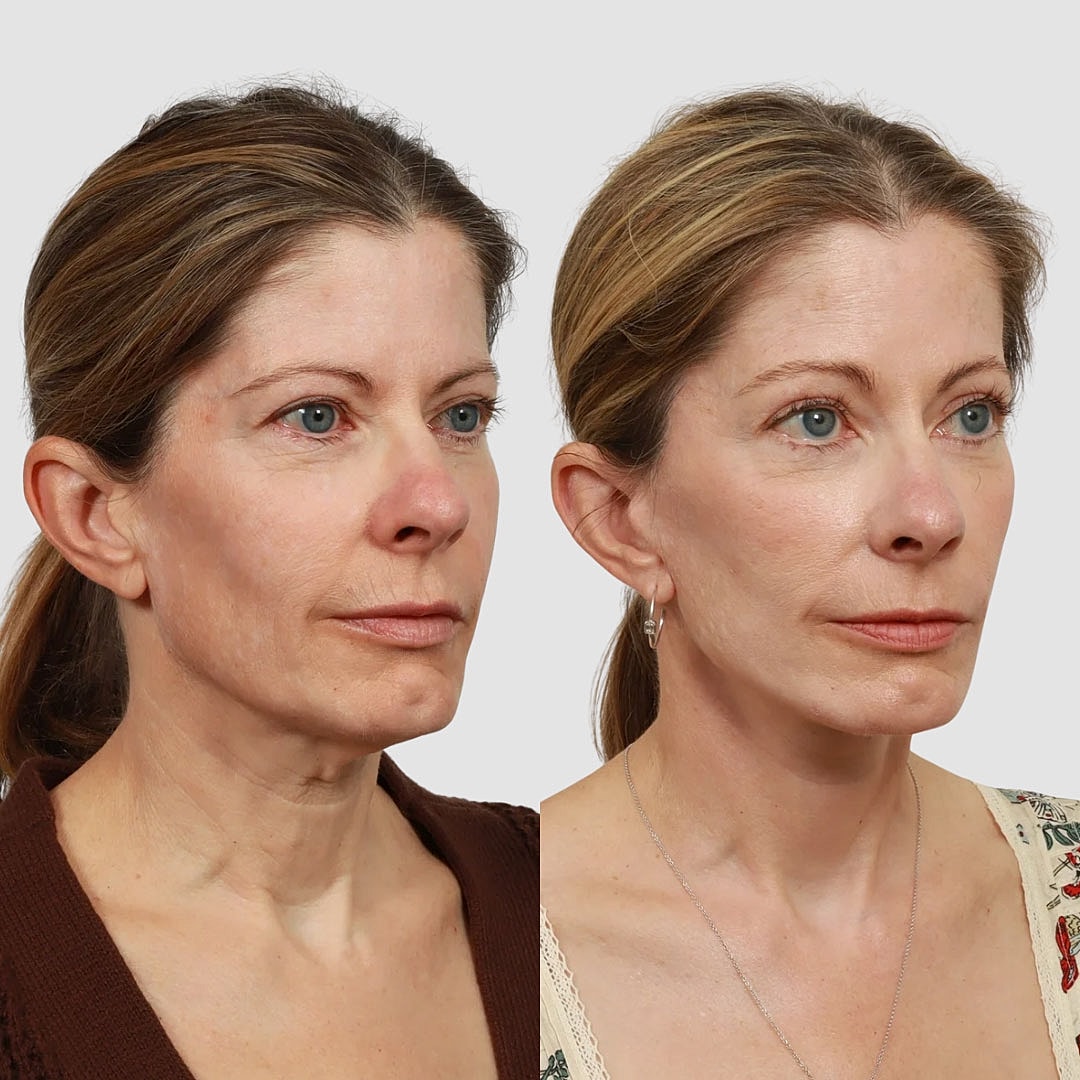 Deep Plane Facelift Before & After