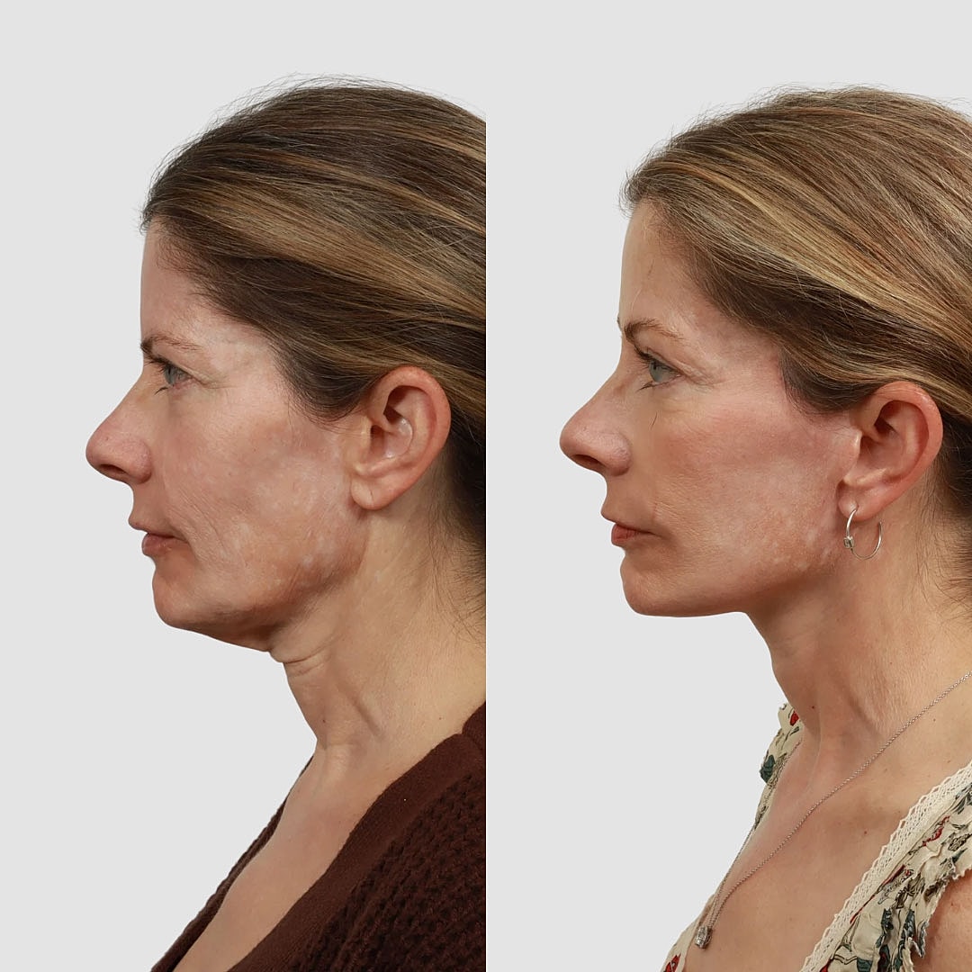 Deep Plane Facelift Before & After