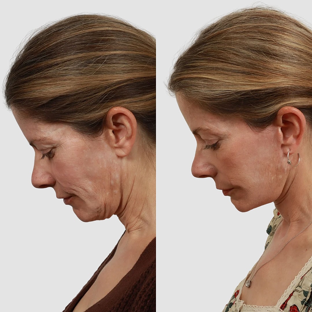 Deep Plane Facelift Before & After