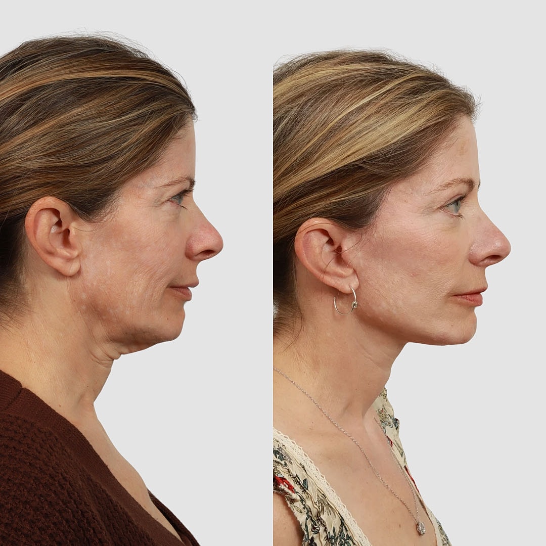 Deep Plane Facelift Before & After