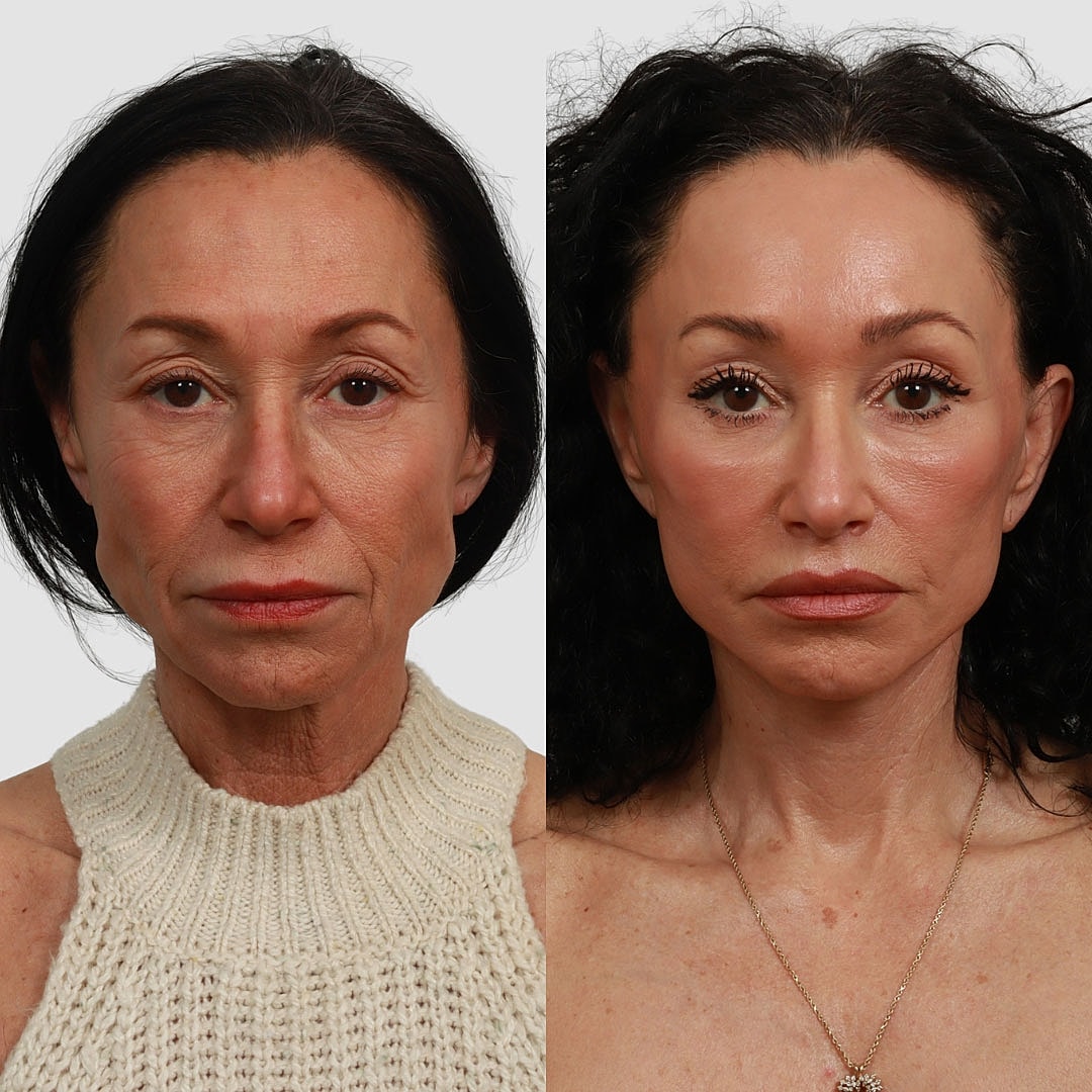 Deep Plane Facelift Before & After