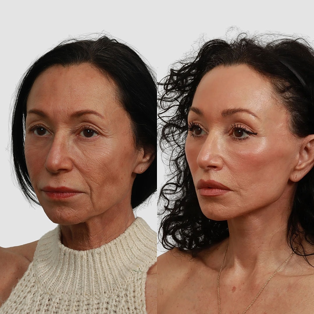 Deep Plane Facelift Before & After
