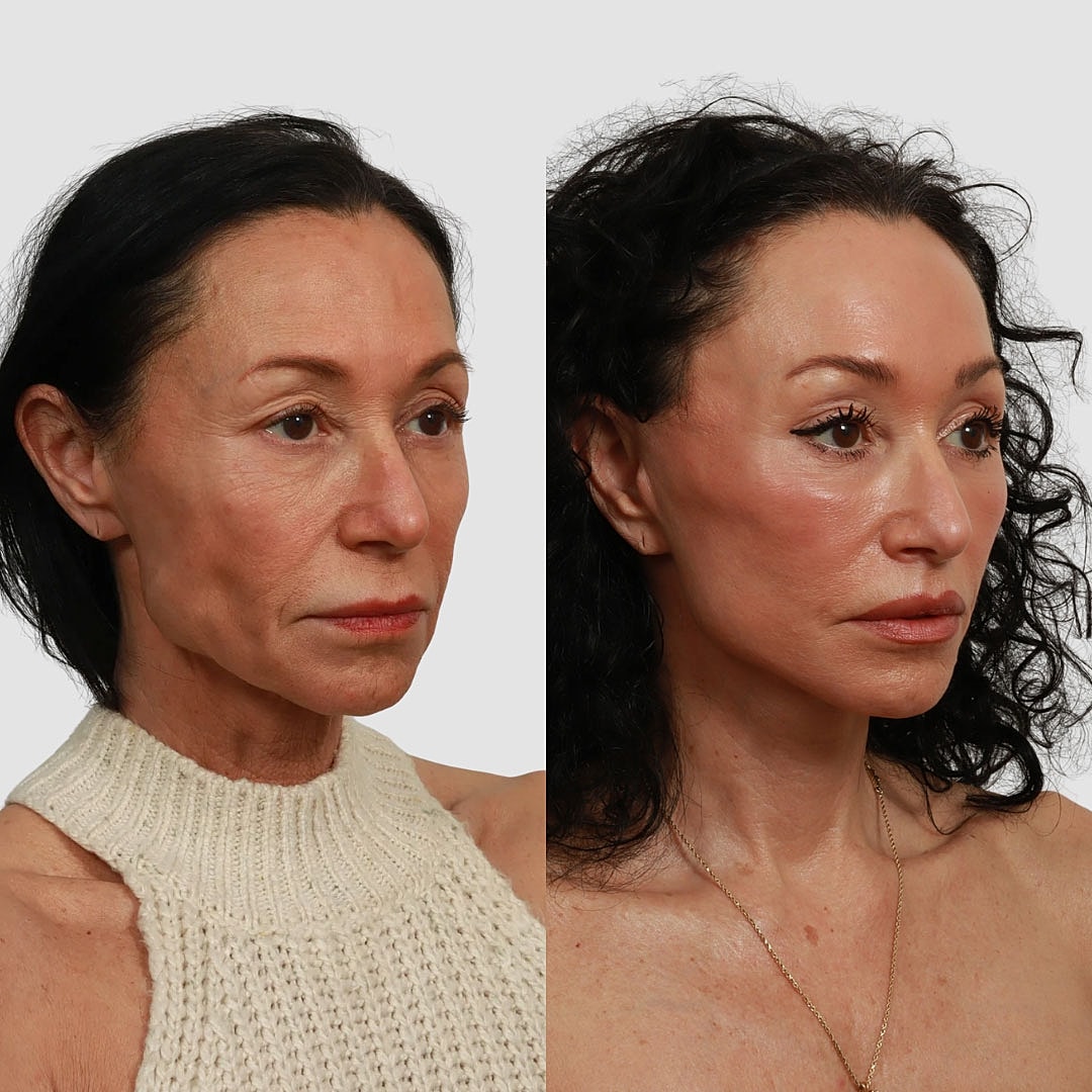 Deep Plane Facelift Before & After