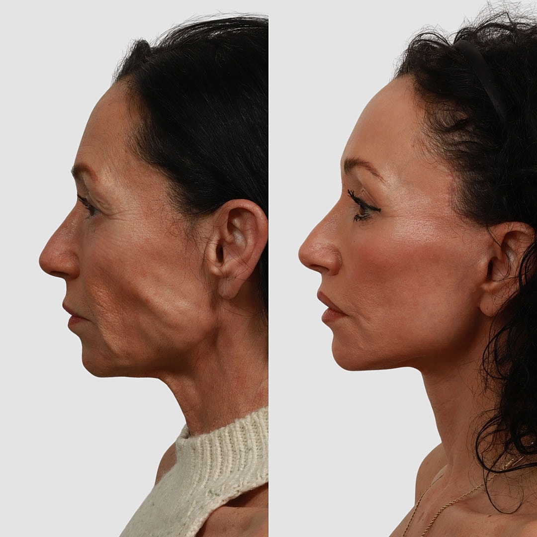 Deep Plane Facelift Before & After
