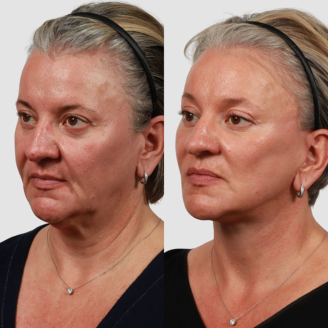 Deep Plane Facelift Before & After