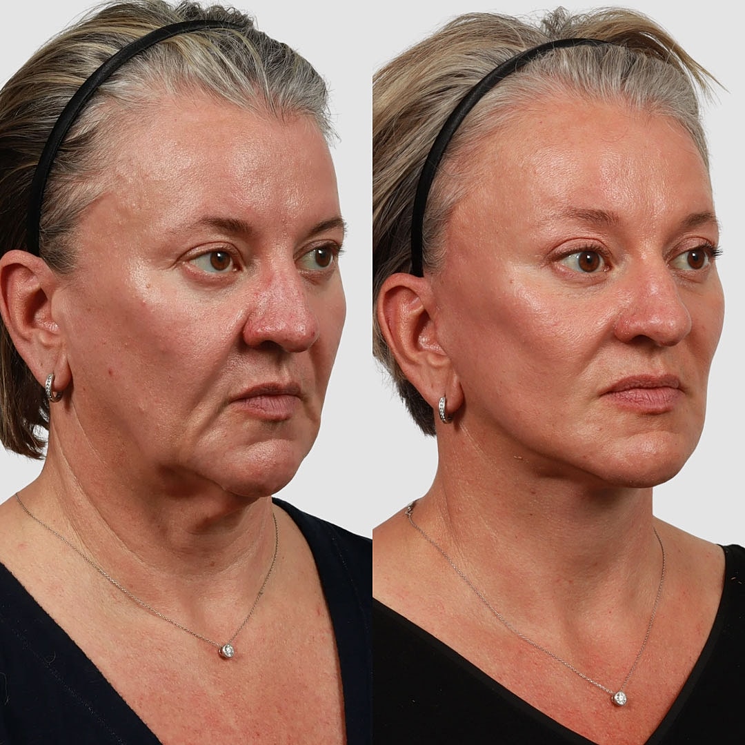 Deep Plane Facelift Before & After