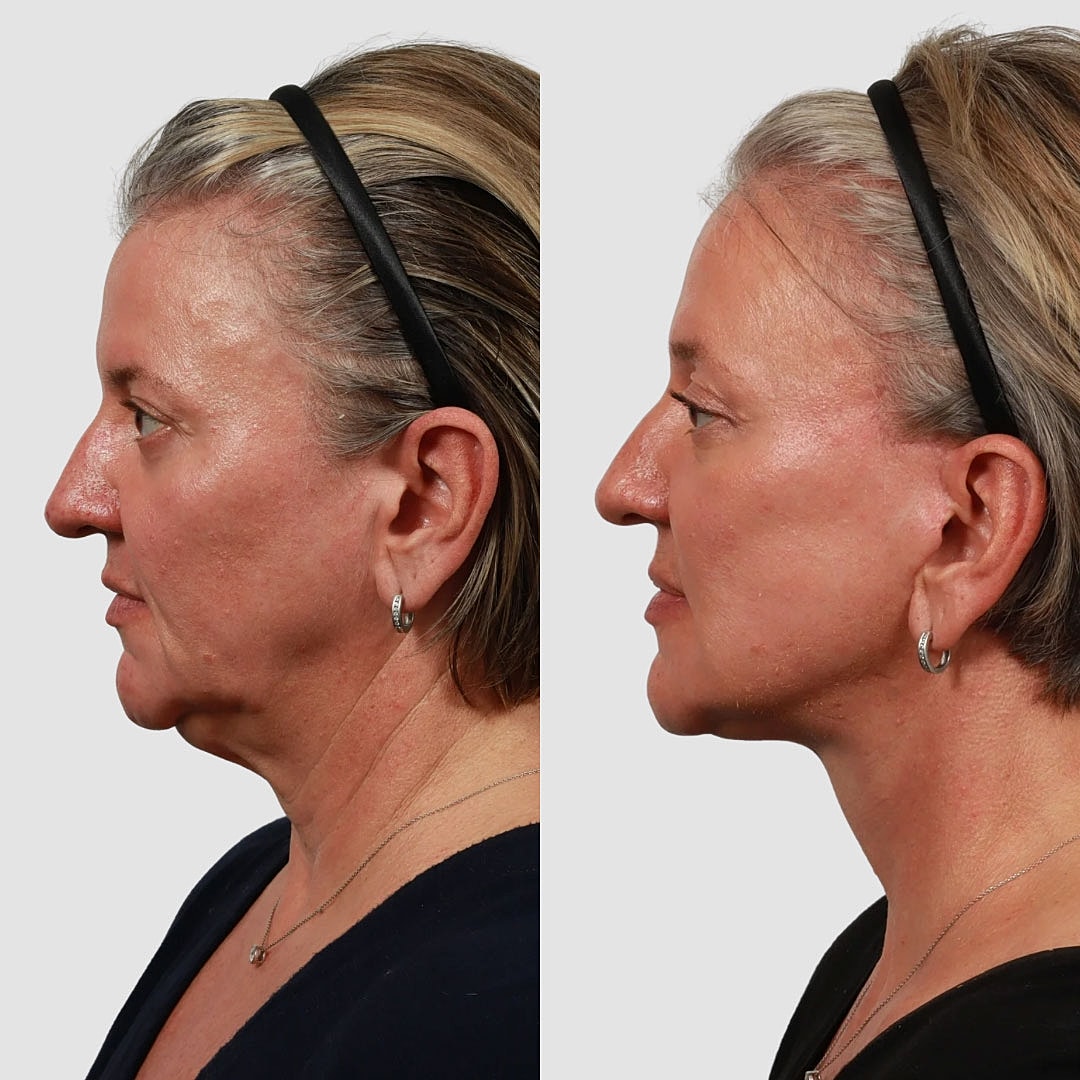 Deep Plane Facelift Before & After