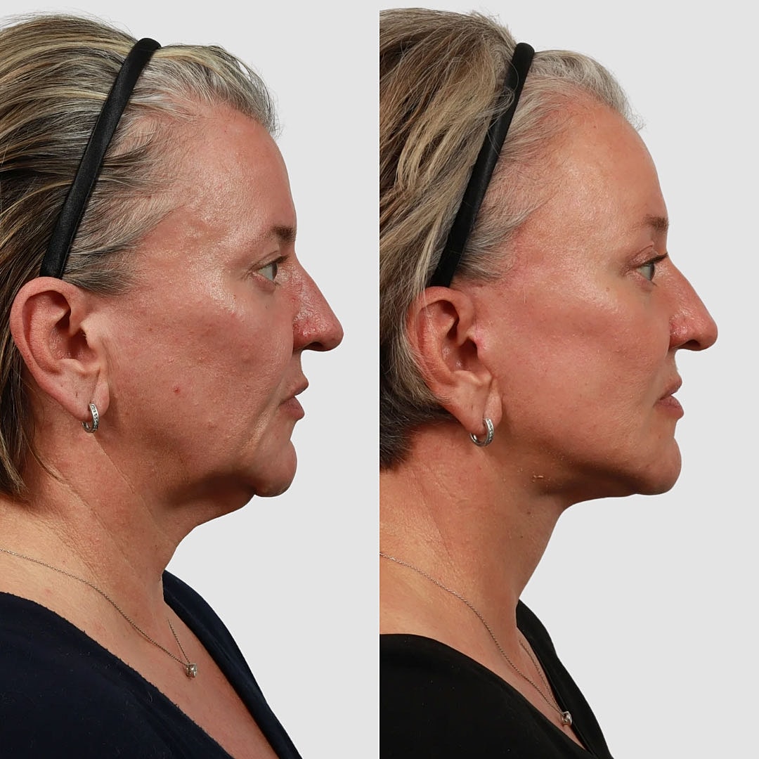 Deep Plane Facelift Before & After