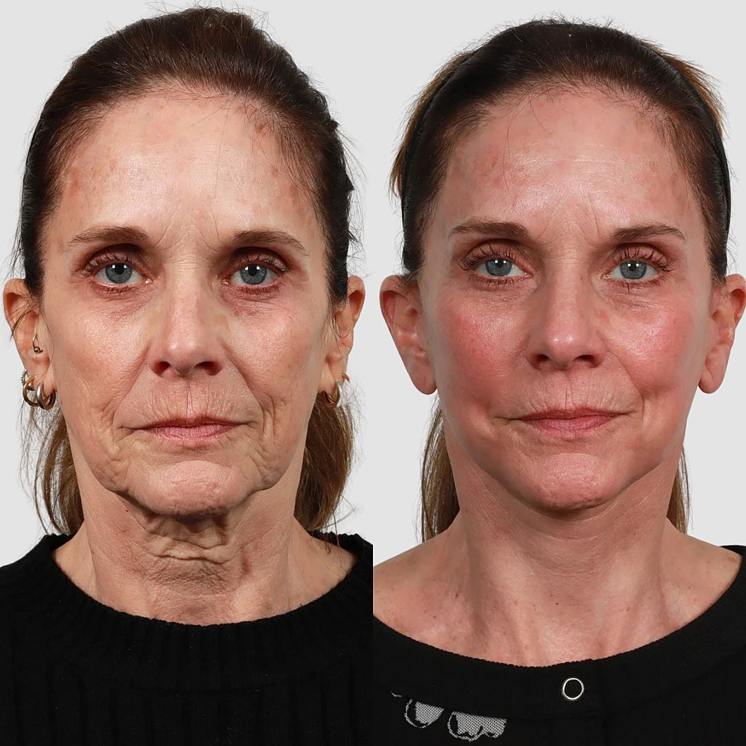 Deep Plane Facelift Before & After