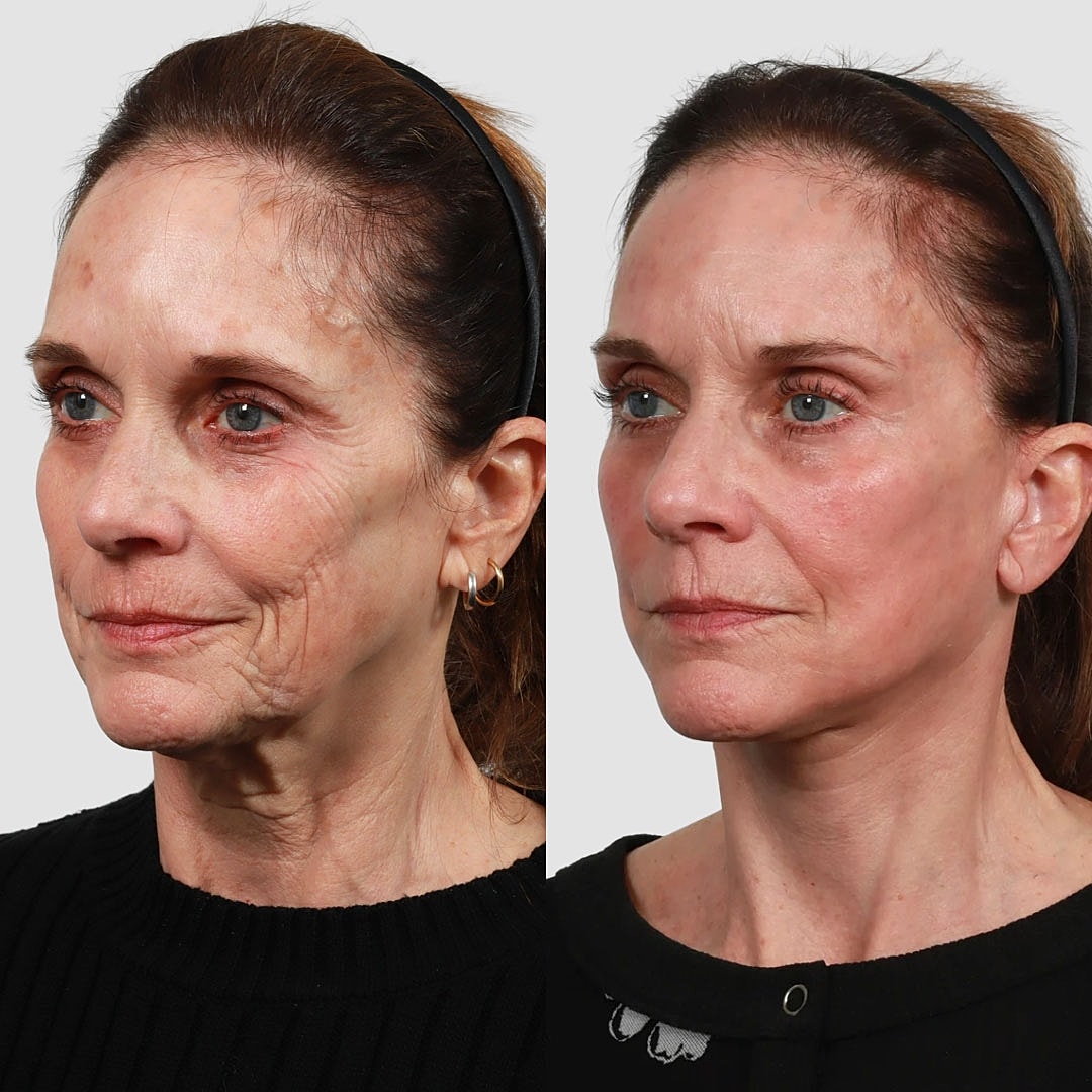 Deep Plane Facelift Before & After
