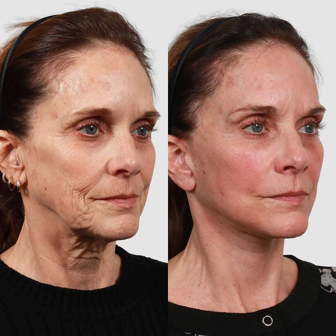 Deep Plane Facelift Before & After