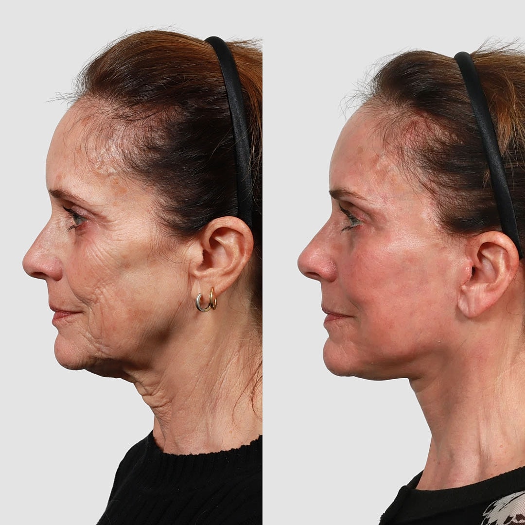 Deep Plane Facelift Before & After