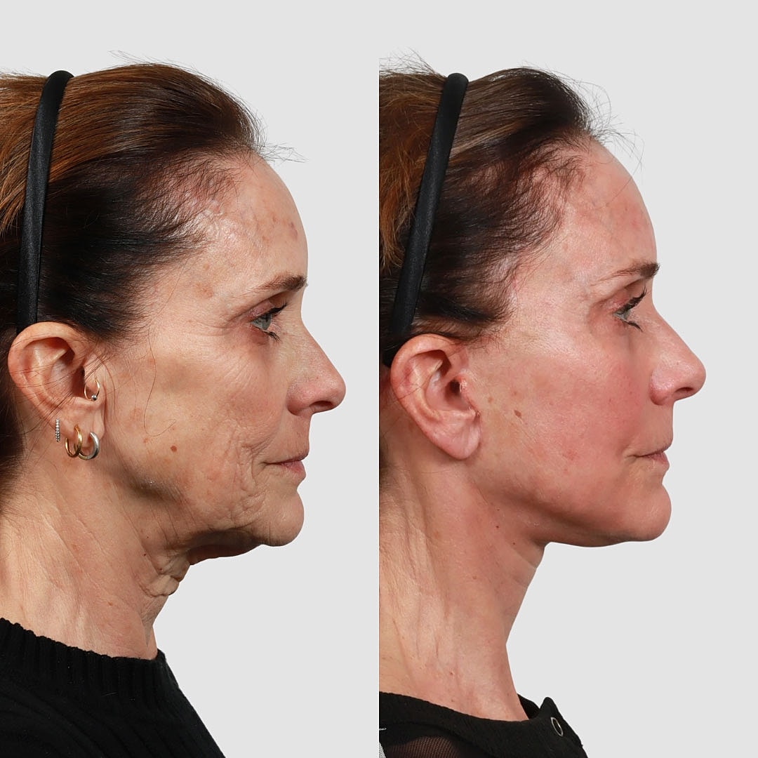 Deep Plane Facelift Before & After