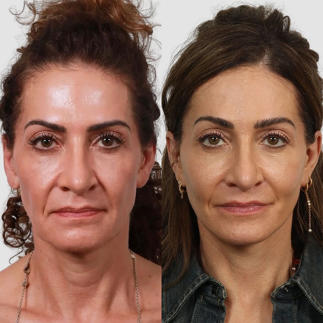 Deep Plane Facelift Before & After