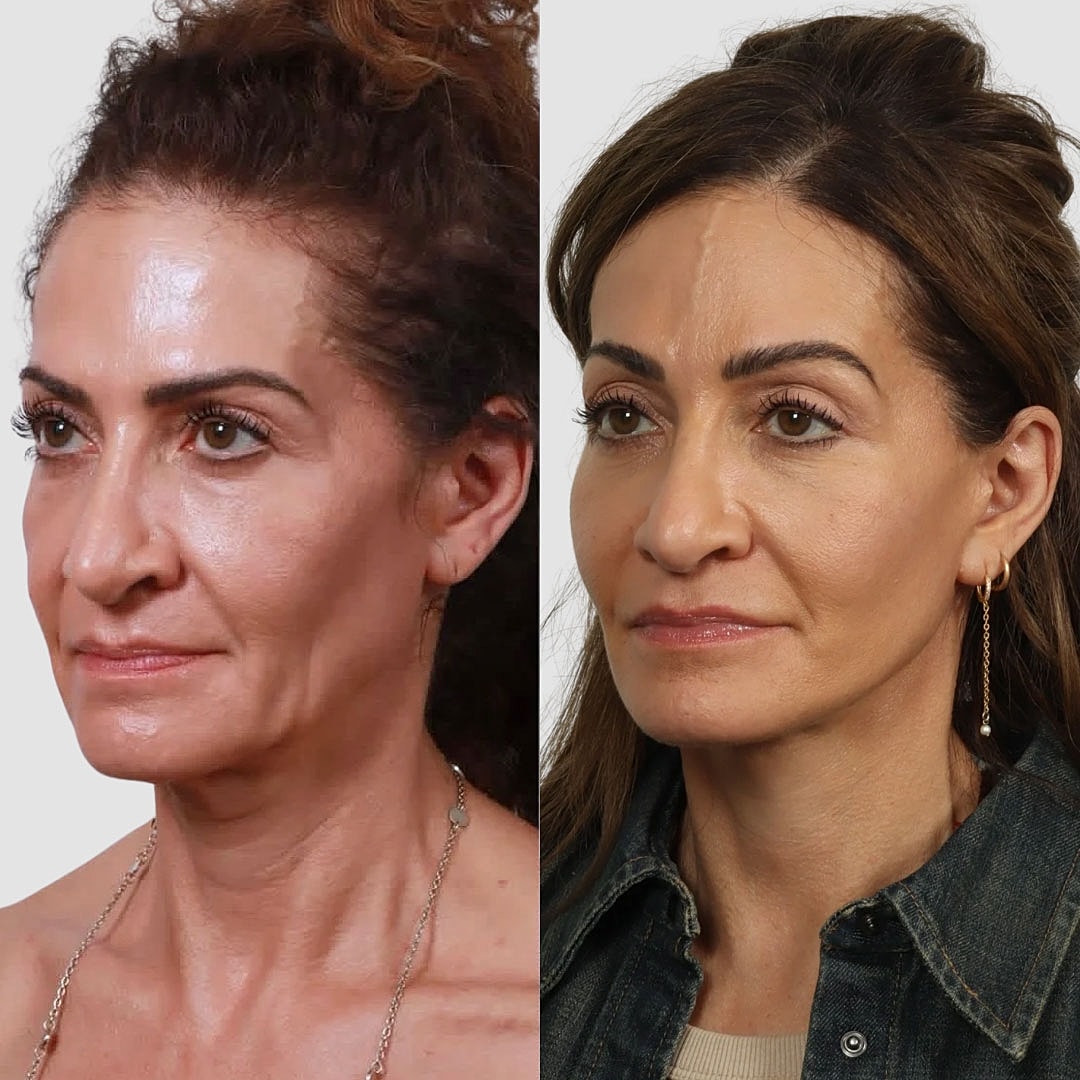 Deep Plane Facelift Before & After