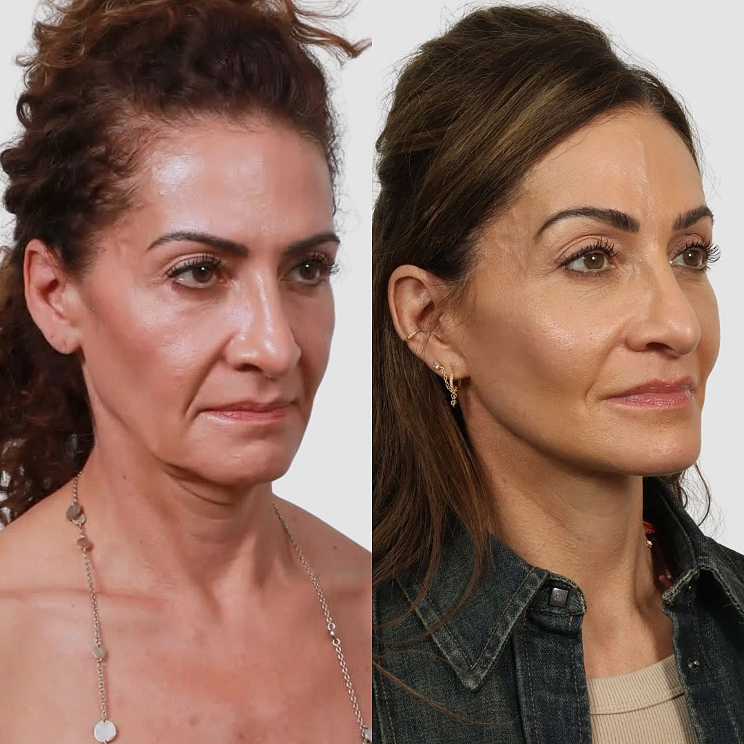 Deep Plane Facelift Before & After