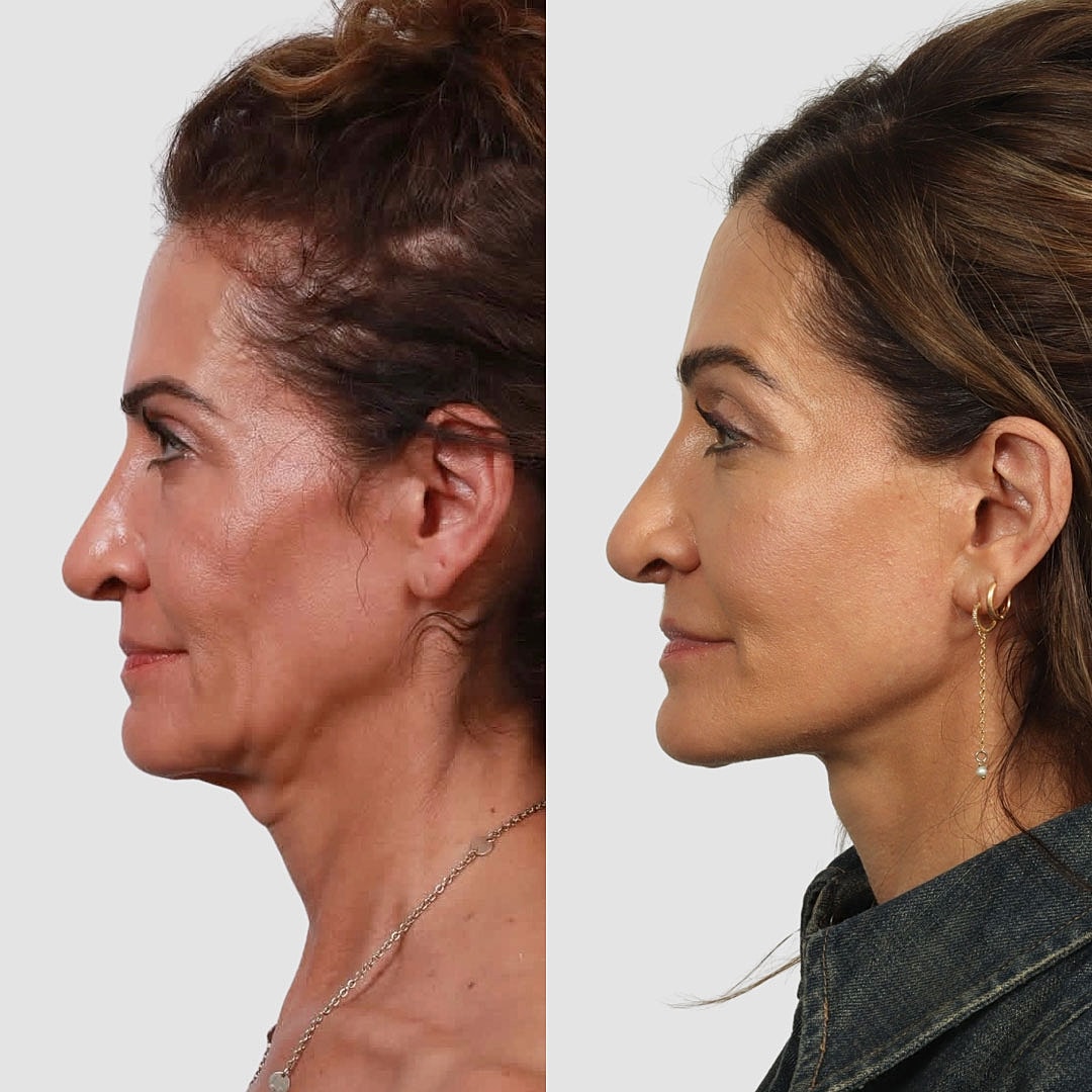 Deep Plane Facelift Before & After