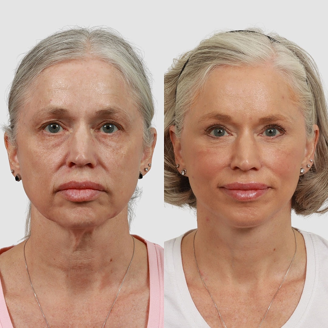 Deep Plane Facelift Before & After