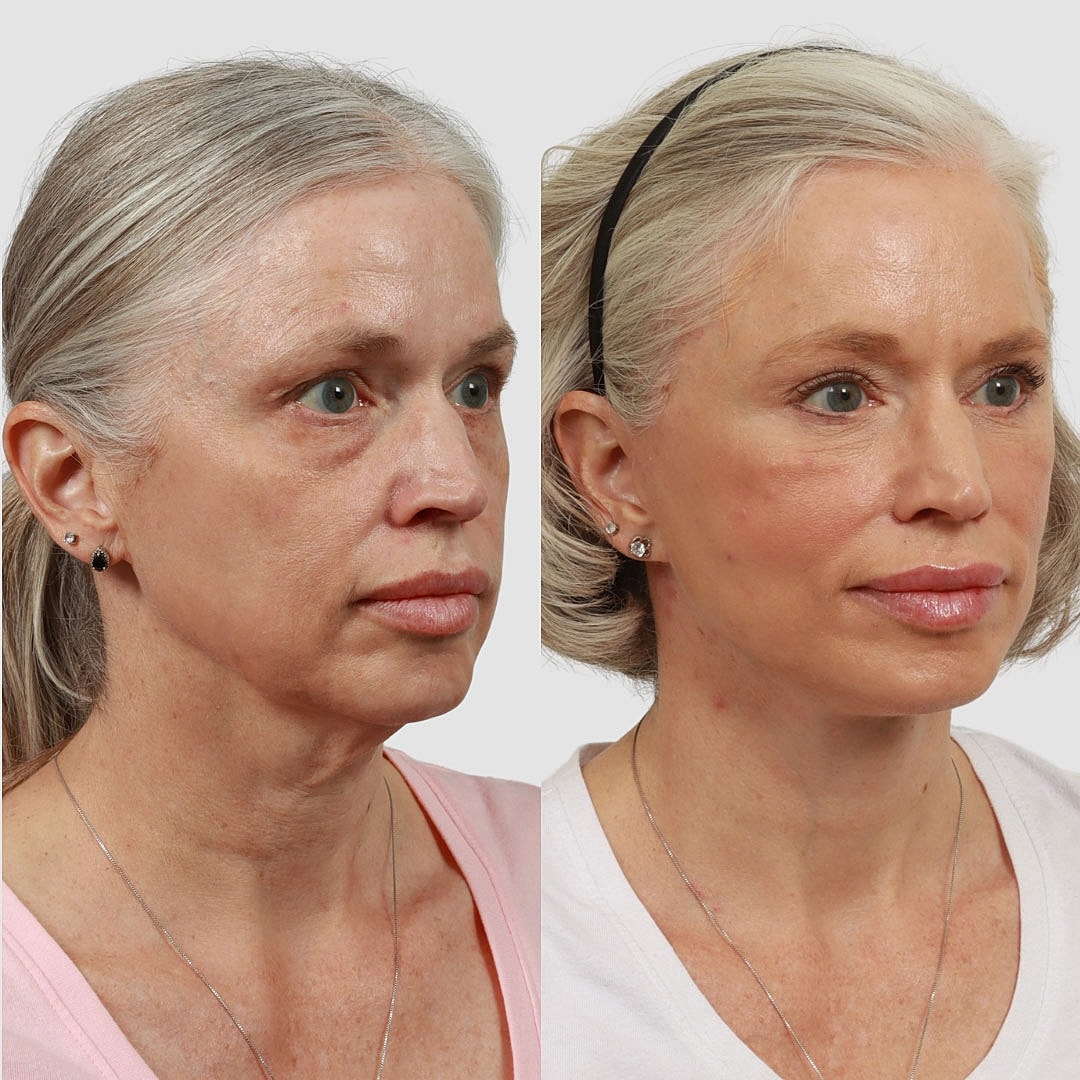 Deep Plane Facelift Before & After