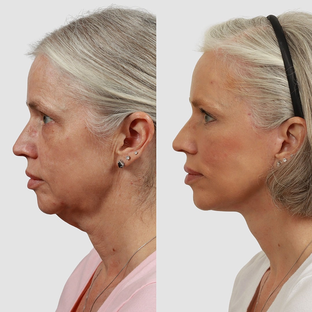 Deep Plane Facelift Before & After