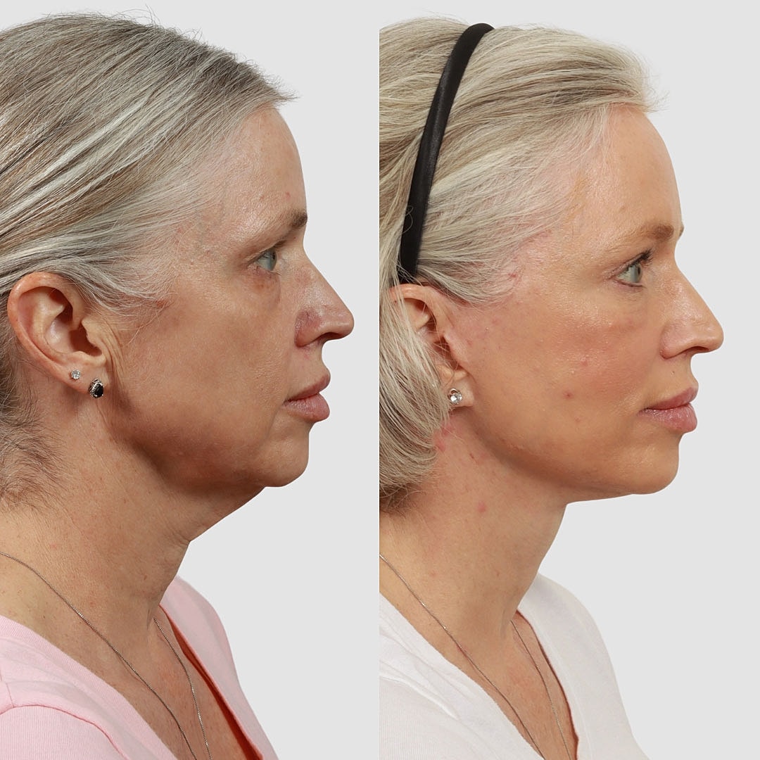 Deep Plane Facelift Before & After