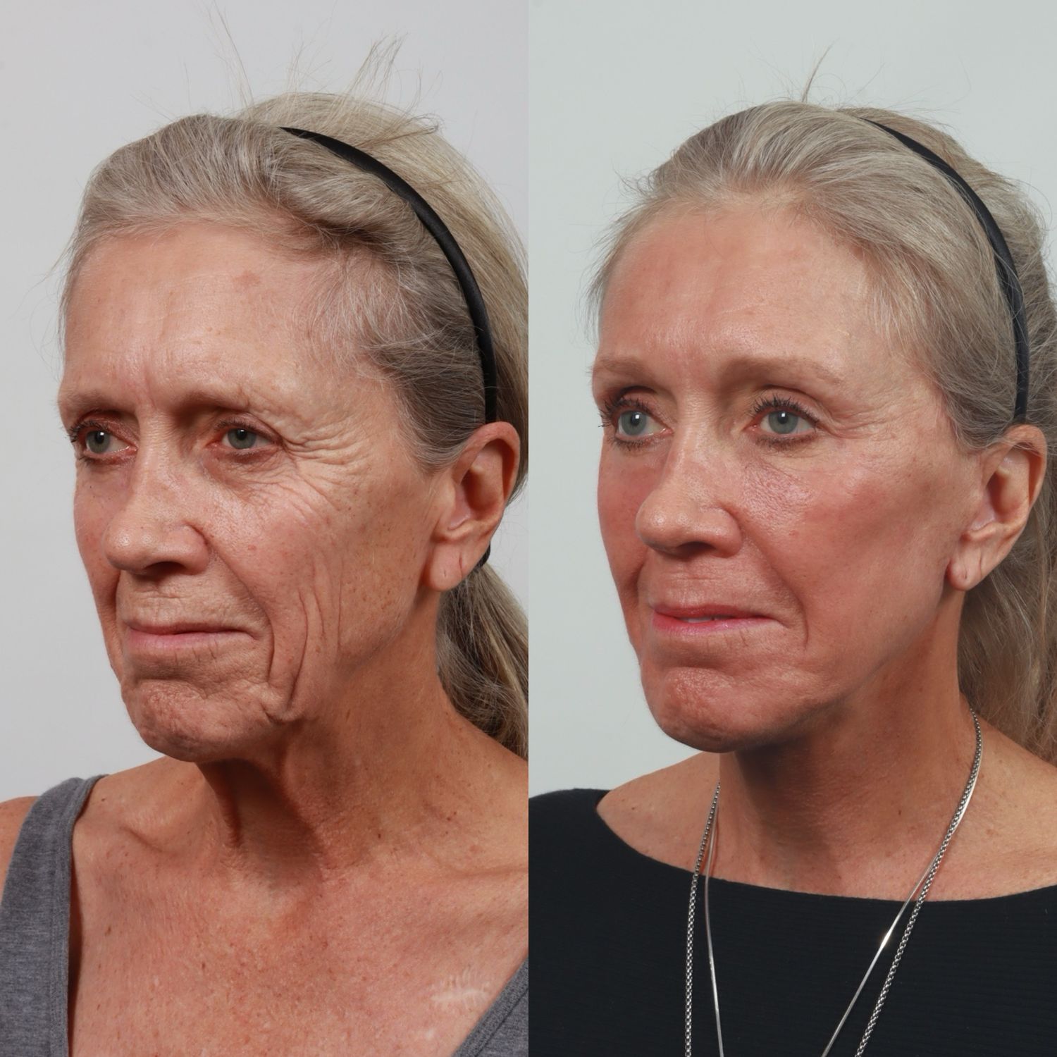 Deep Plane Facelift Before & After