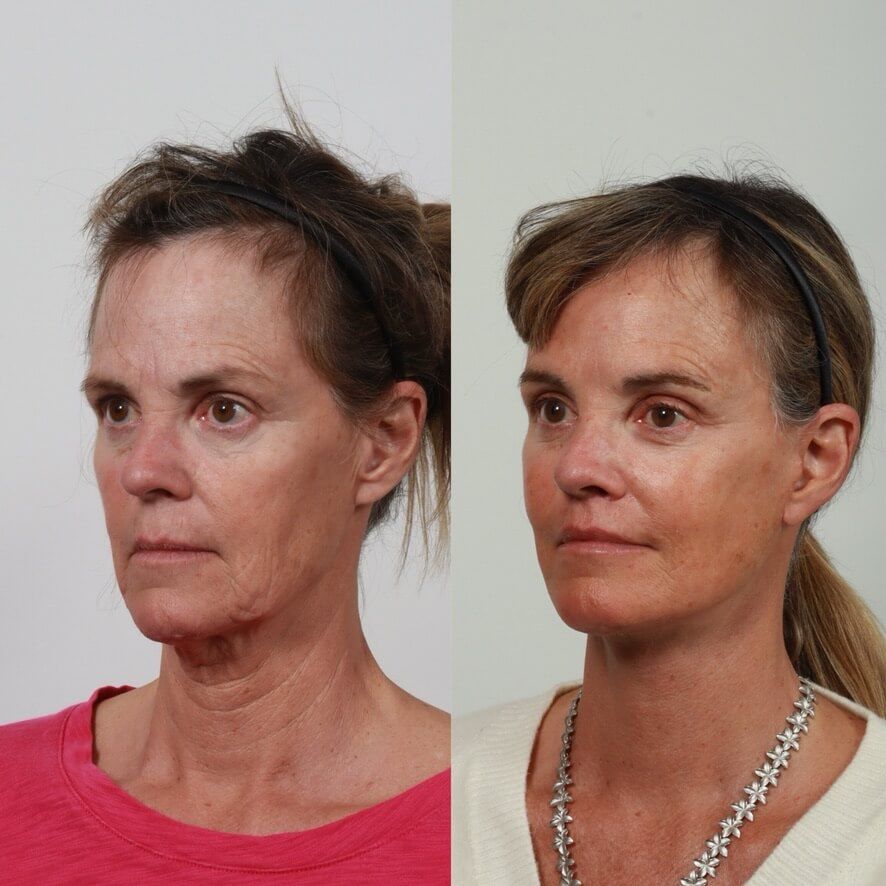 Deep Plane Facelift Before & After