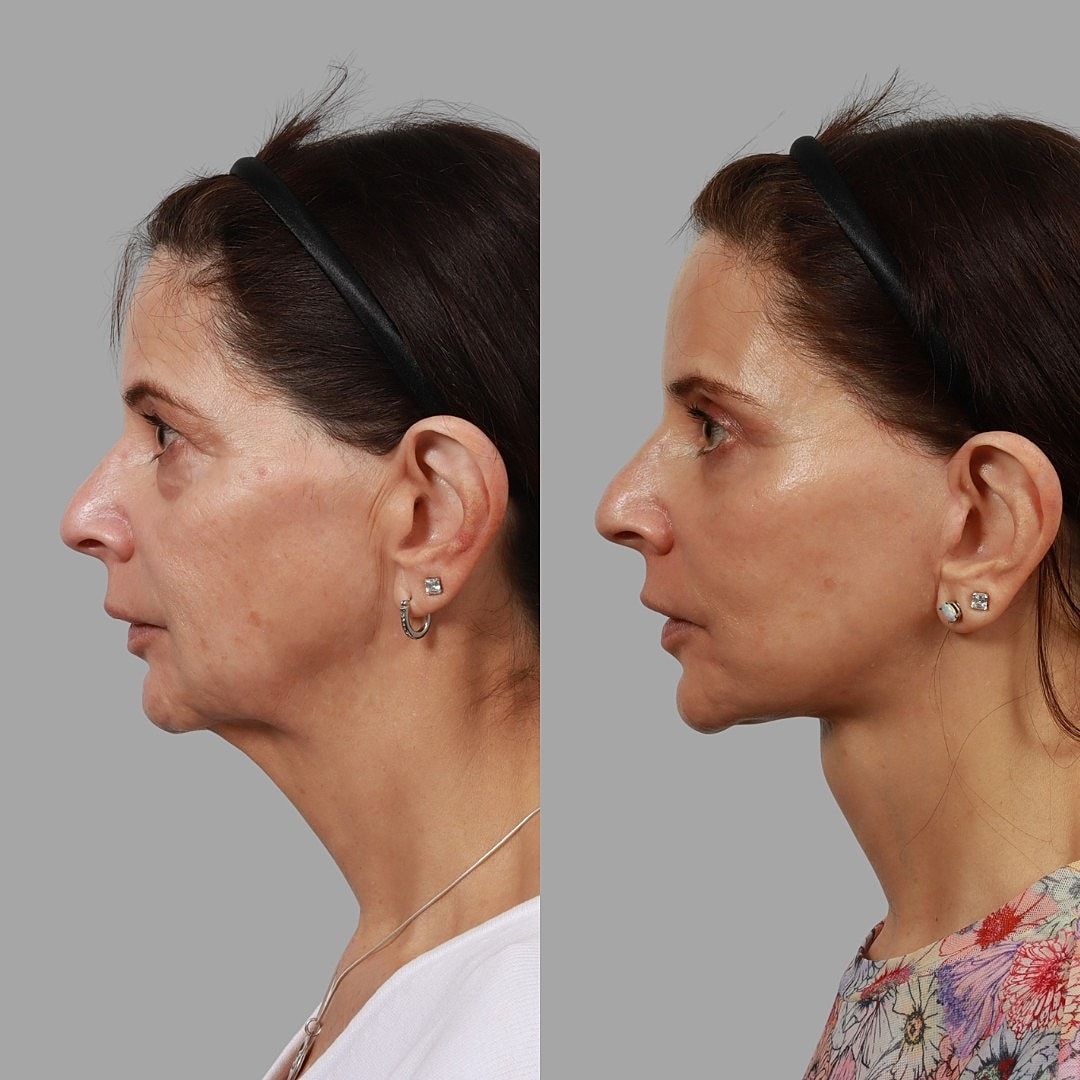 Deep Plane Facelift Before & After
