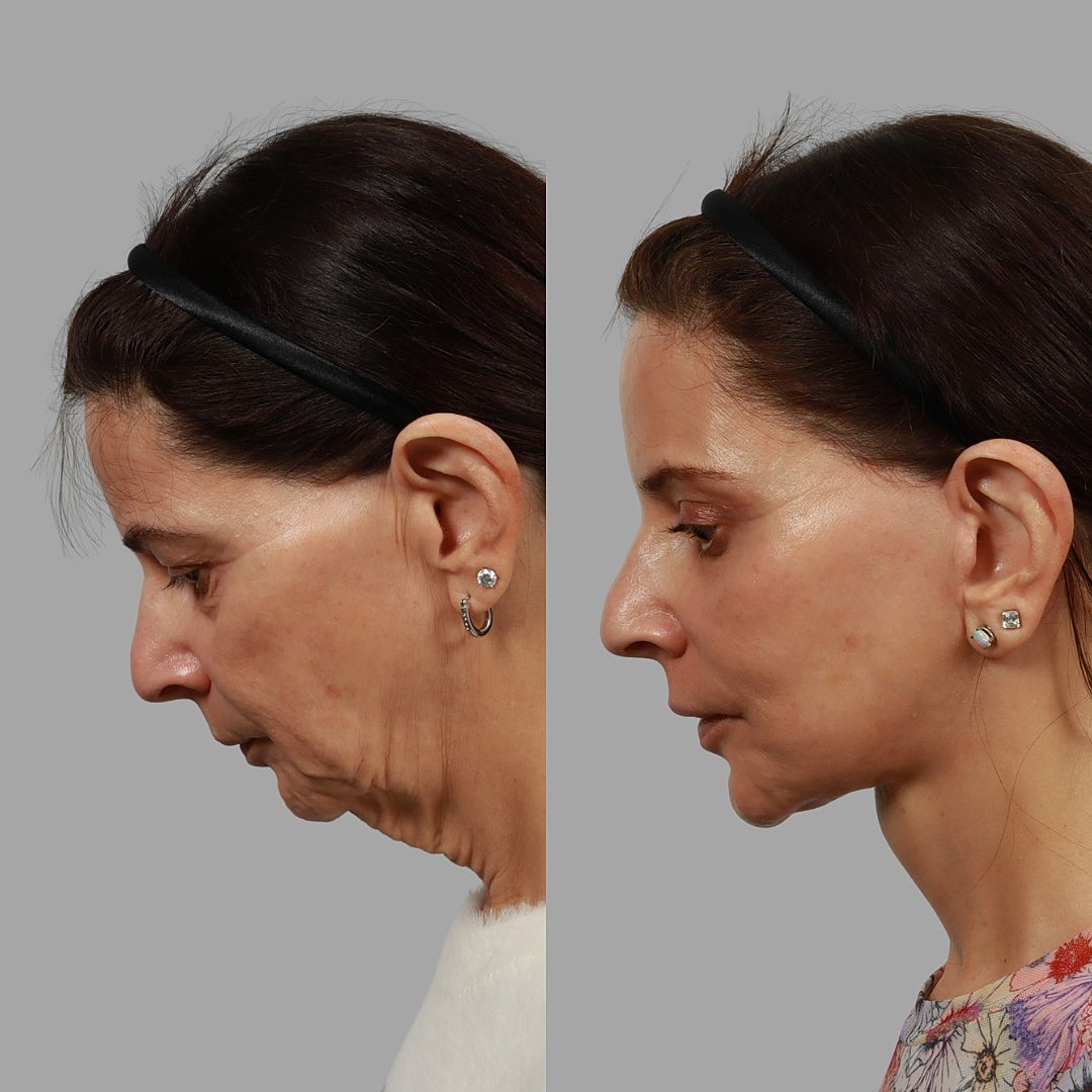 Deep Plane Facelift Before & After