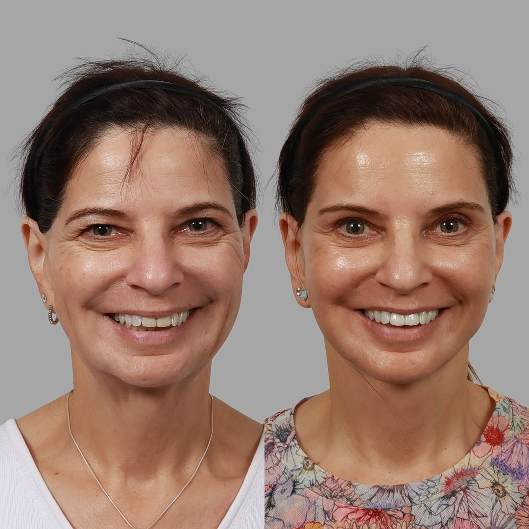 Deep Plane Facelift Before & After