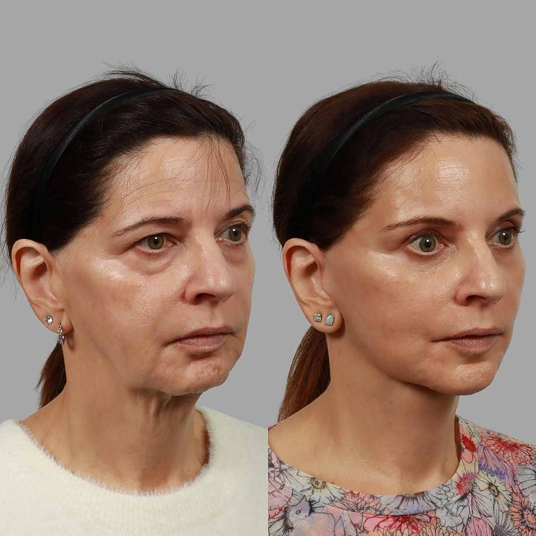 Deep Plane Facelift Before & After