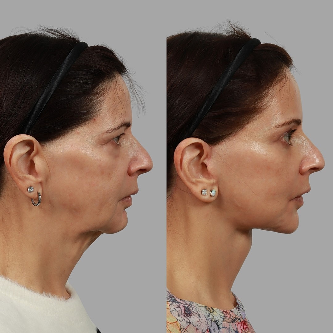 Deep Plane Facelift Before & After