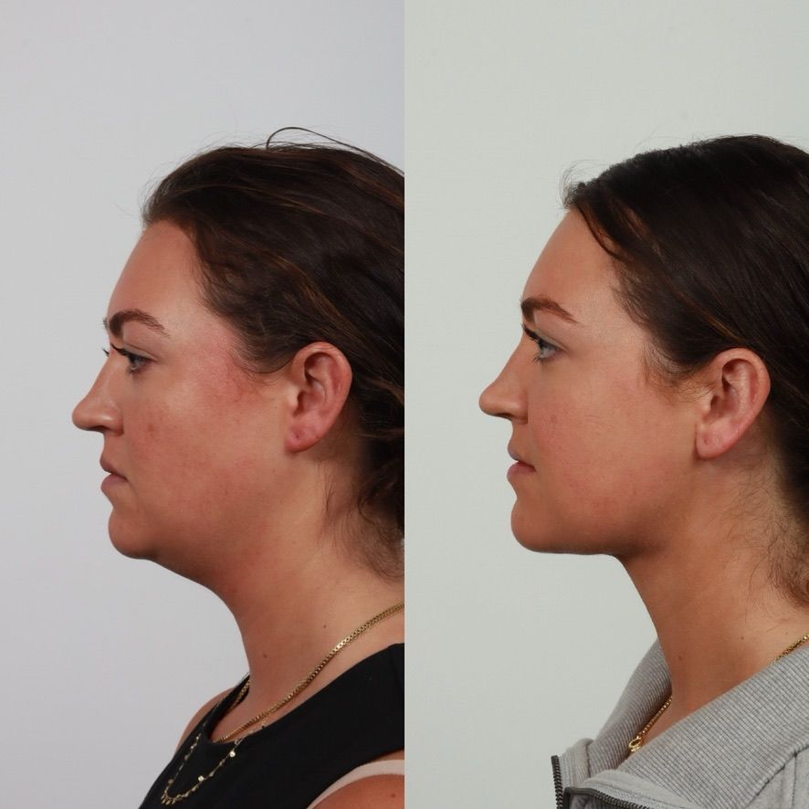 Deep Plane Neck Lift Before & After