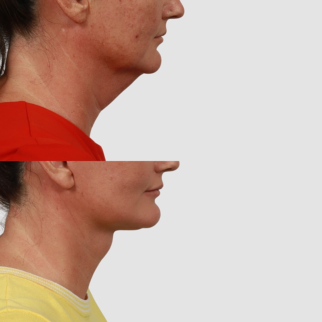 Deep Plane Neck Lift Before & After