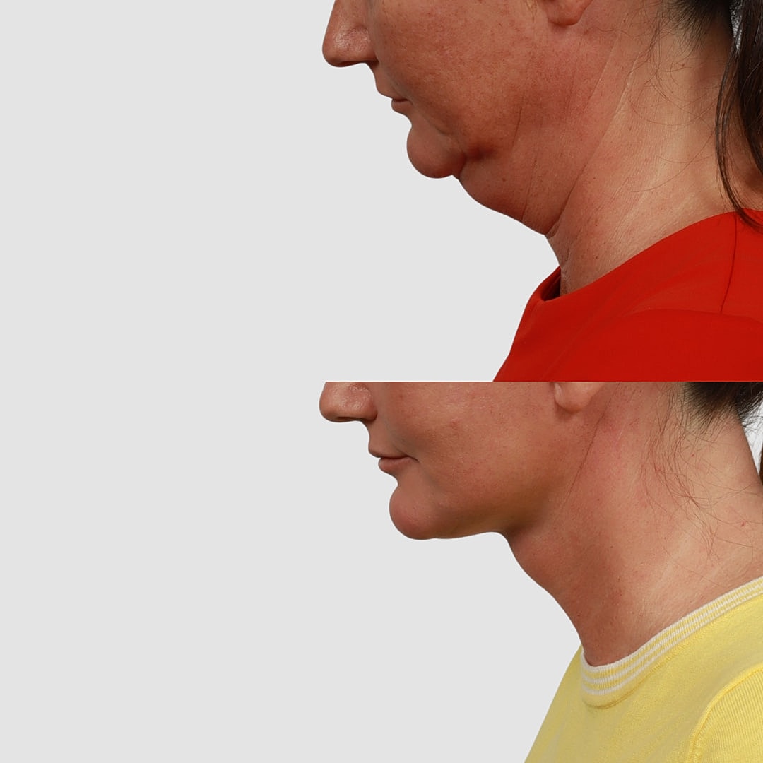 Deep Plane Neck Lift Before & After