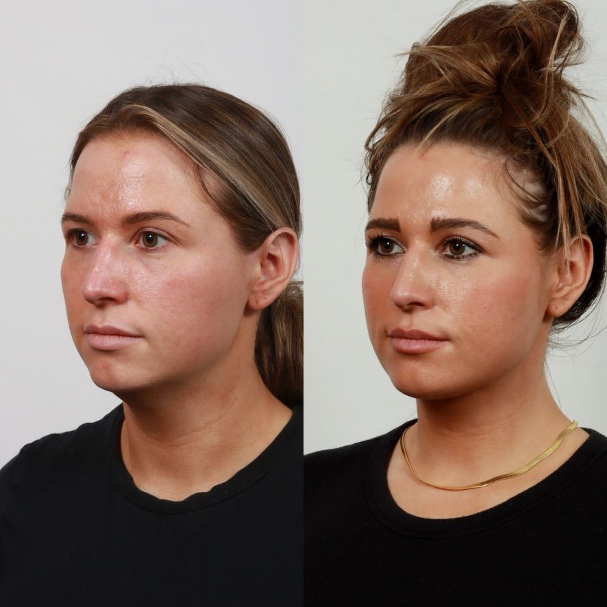 Deep Plane Neck Lift Before & After