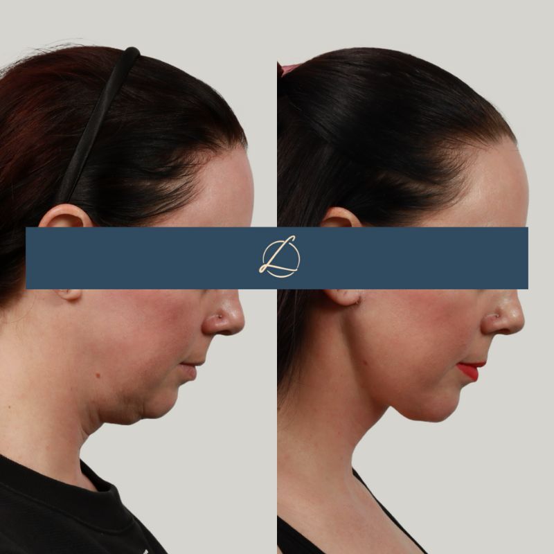 Deep Plane Neck Lift Before & After