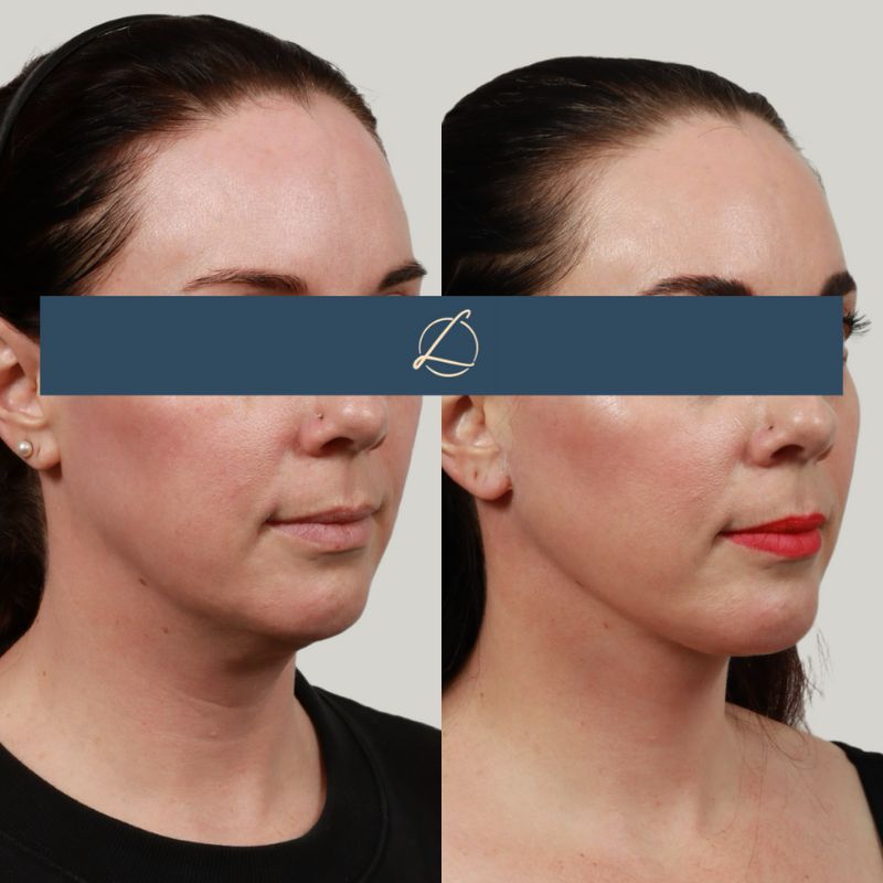 Deep Plane Neck Lift Before & After