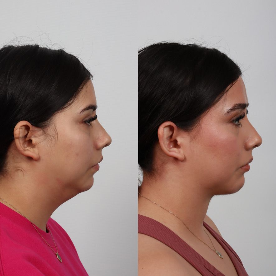 Deep Plane Neck Lift Before & After
