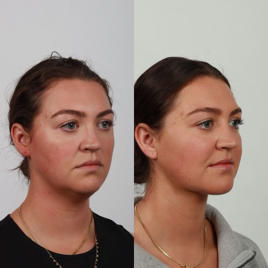 Deep Plane Neck Lift Before & After