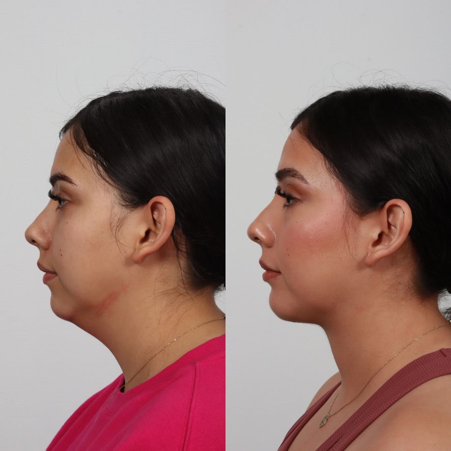 Deep Plane Neck Lift Before & After