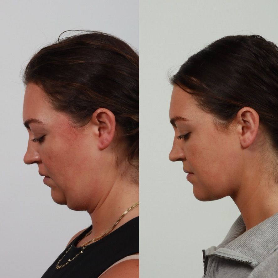 Deep Plane Neck Lift Before & After