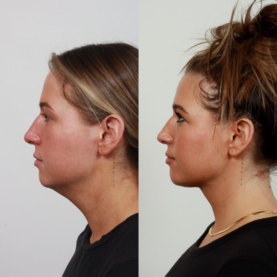 Deep Plane Neck Lift Before & After