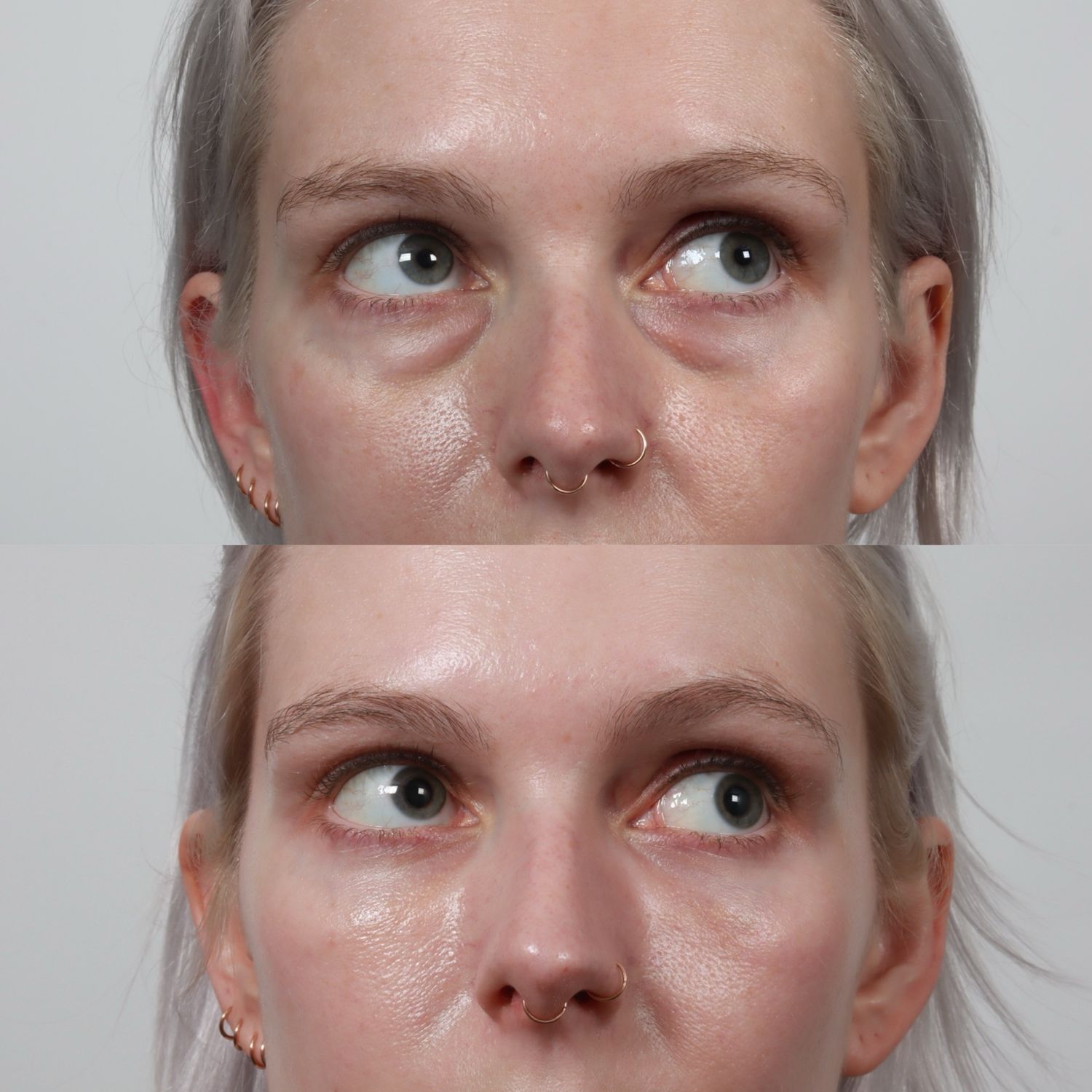 Blepharoplasty Before & After