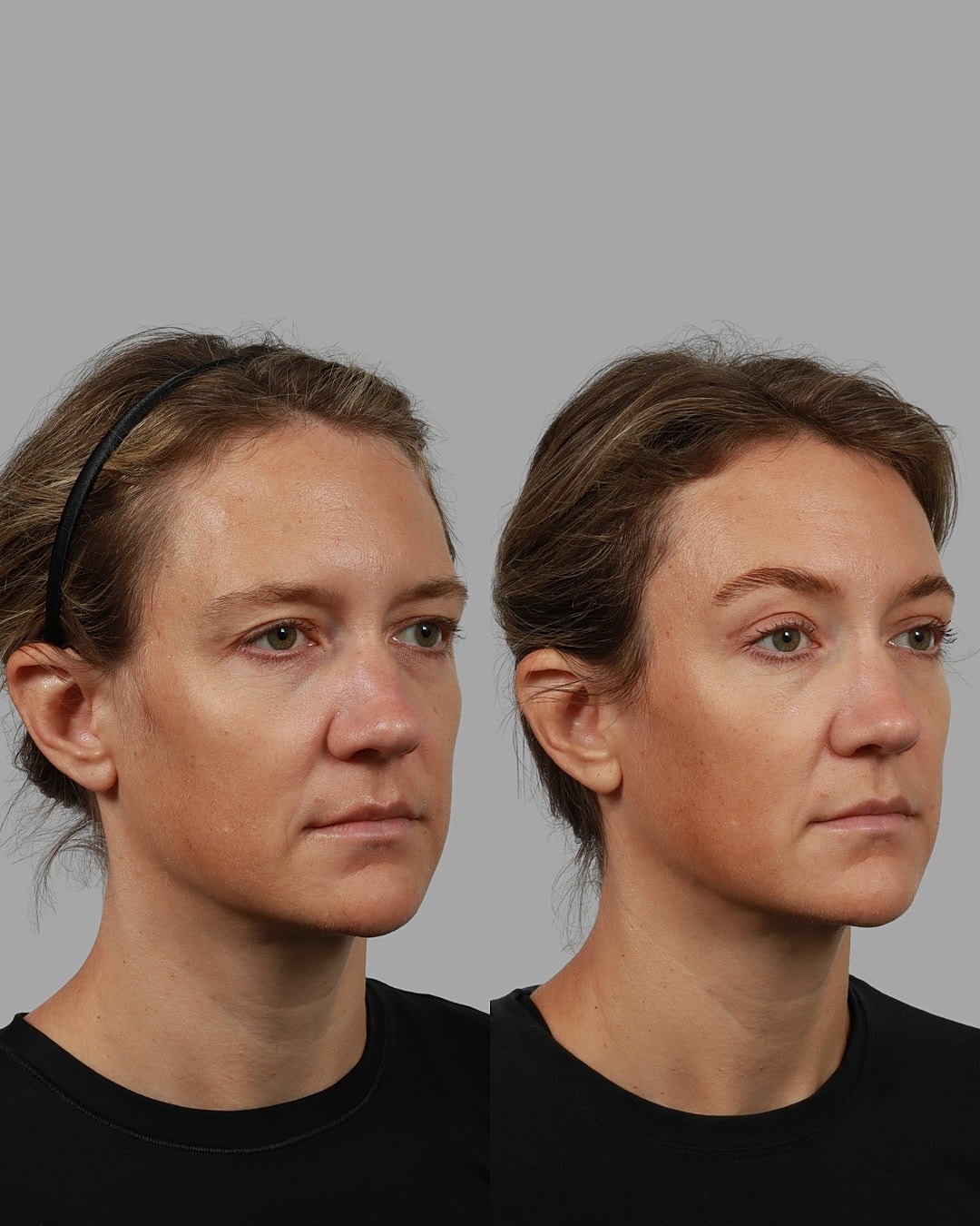 Blepharoplasty Before & After