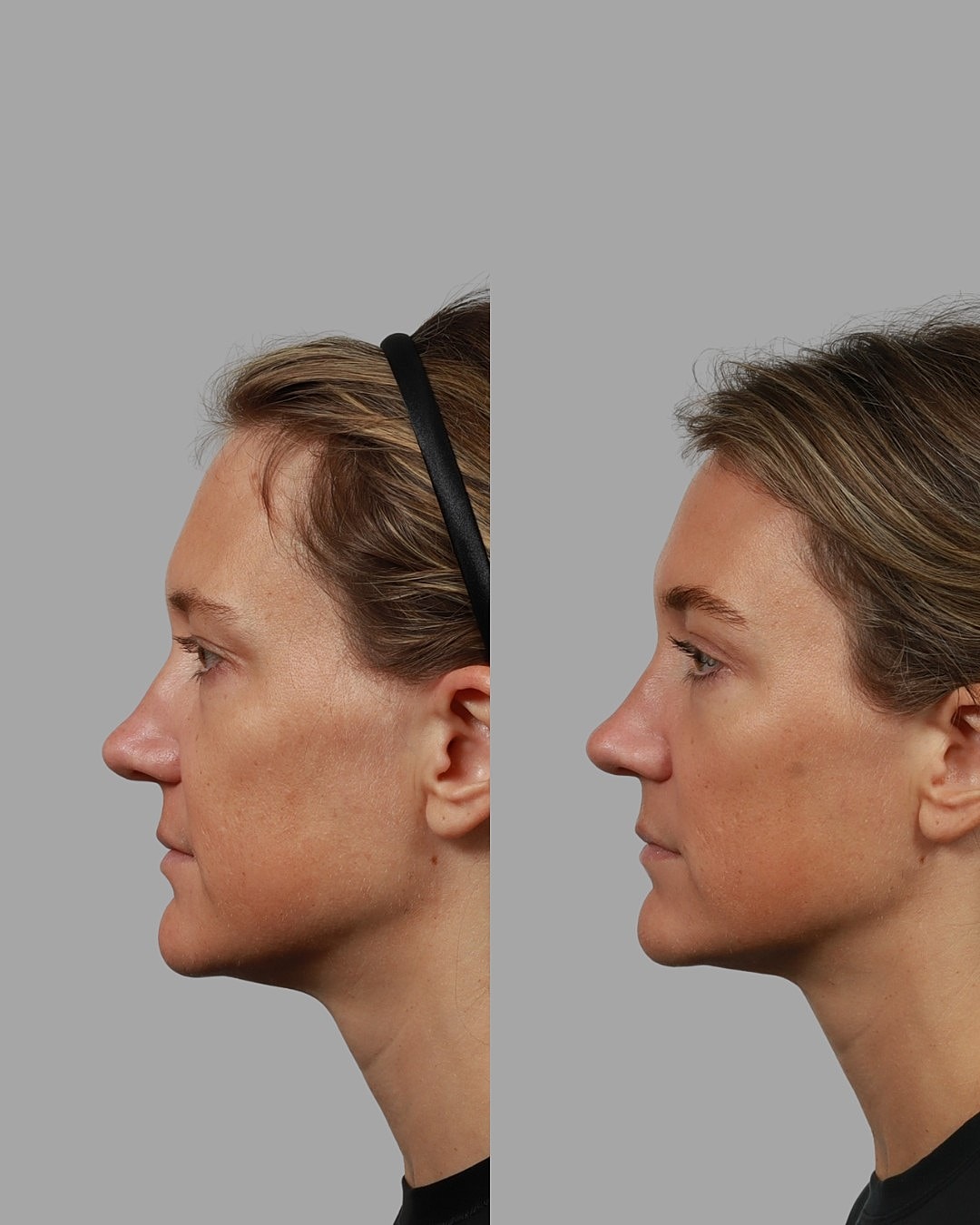 Blepharoplasty Before & After