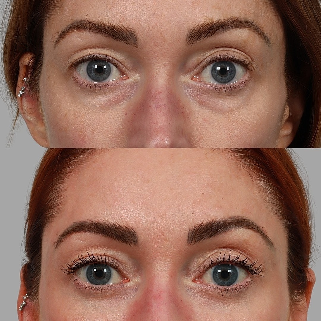 Blepharoplasty Before & After