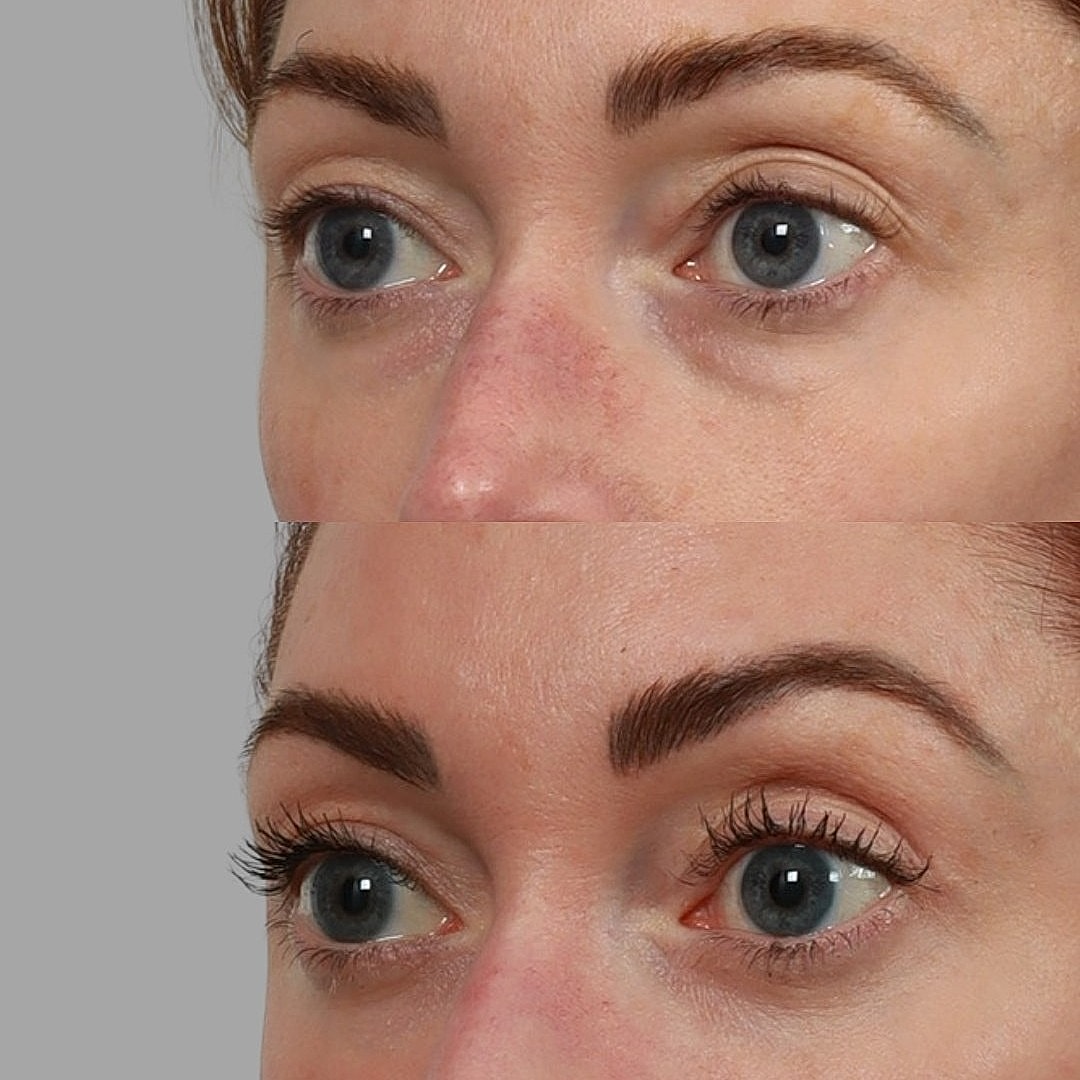 Blepharoplasty Before & After