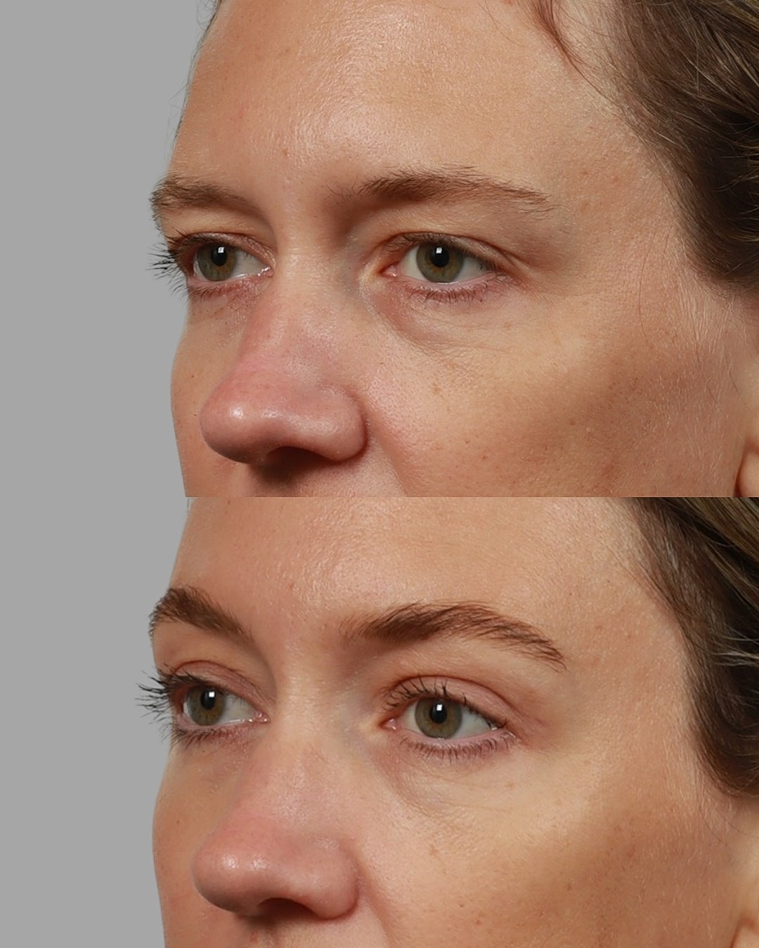 Blepharoplasty Before & After